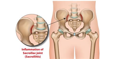 Sacroiliitis : Symptoms, Causes, Treatment, Home Remedies & Exercises