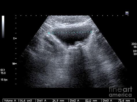 Bladder Stones, Ultrasound Scan By Science Photo Library