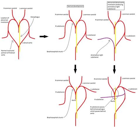 Subclavian Artery: Anatomy, Branches, Mnemonic, Clinical Points | Learn ...