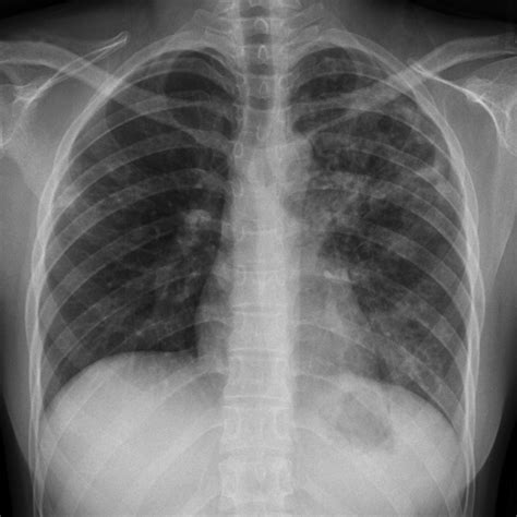 Disseminated Tuberculosis Image Radiopaediaorg