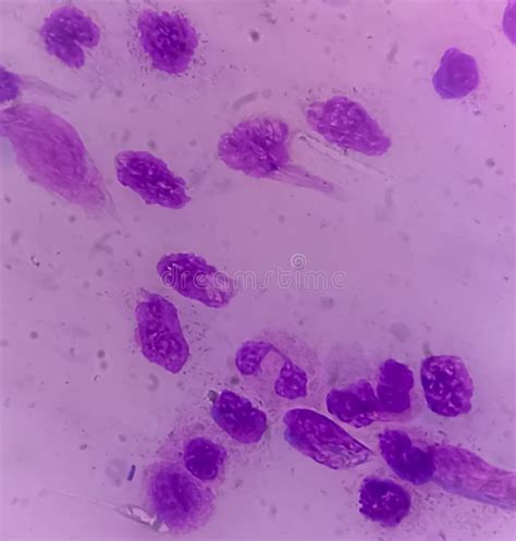 Blood Cancer. Acute Myeloblastic Leukemia or AML, Stock Image - Image of lymphoblastic ...