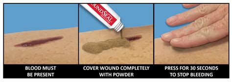 WoundSeal For Cuts & Lacerations | WoundSeal.com – Stop Bleeding Instantly