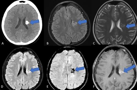 Radiological imaging of the brain stone A: Non-contrast enhanced... | Download Scientific Diagram