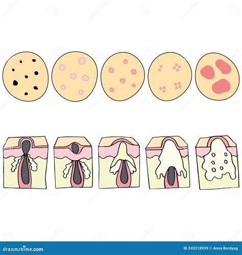 Types of Acne. Open Comedones, Closed Comedones, Inflammatory Acne, Cystic Acne. Healthy Skin ...