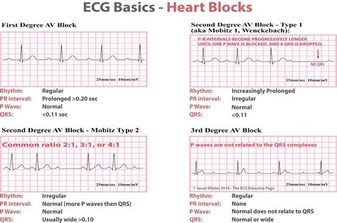 Mastering EKG Basics: Learn how to Calculate Heart Rate