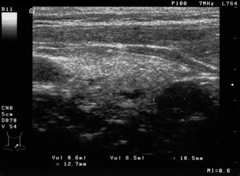 Parathyroid adenoma - wikidoc