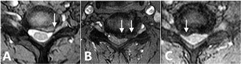 (A) Axial T2-weighted MRI showed ventral nerve root (VNR) compression... | Download Scientific ...