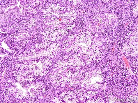 Clear Cell Carcinoma of Endometrium