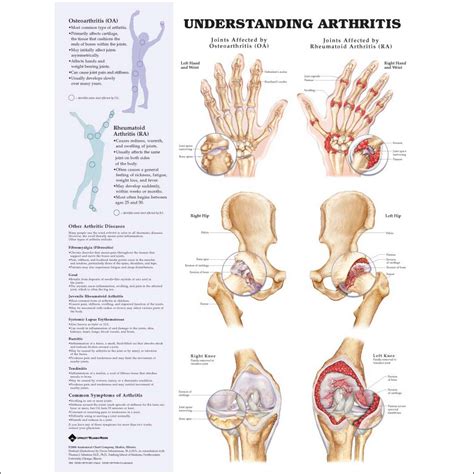 HEALTH WISE: Arthritis and its effects