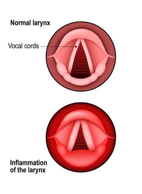 Croup - Harvard Health