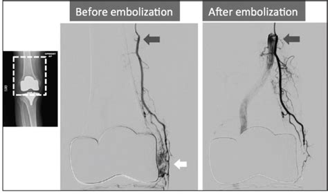 Endovascular Today - Embolization for OA: Which Patients Are the Most Suitable Candidates ...