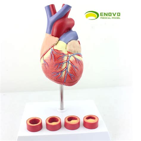 Coronary heart disease coronary artery stenosis coronary artery stenosis-in Medical Science from ...