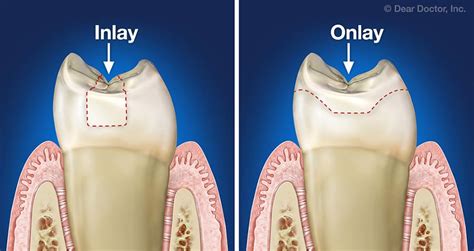 Inlays & Onlays | Northwest Dental | Glyndon Maryland