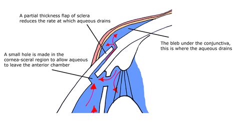 Trabeculectomy - EyeGuru