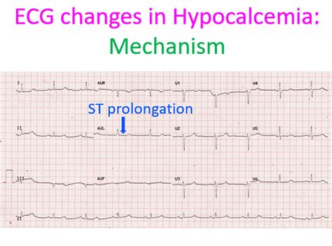 Hypocalcemia Ekg