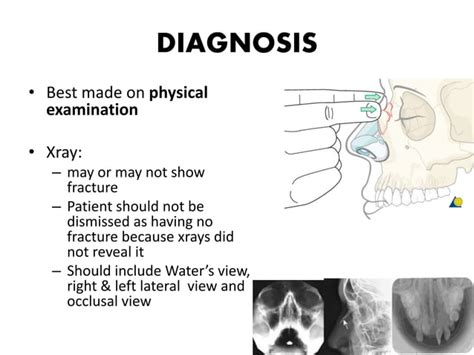 NASAL BONE FRACTURE