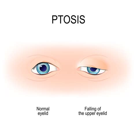 Everything You Need to Know About Ptosis