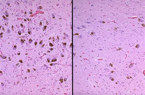 CNS Degenerative Diseases Tutorial