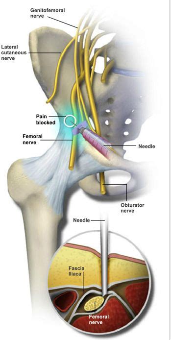 A fascia iliaca block is performed to block pain signals from traveling along the femoral nerve ...