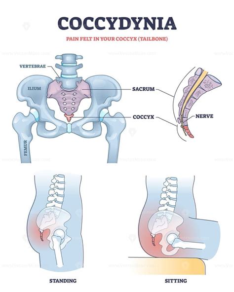 Coccydynia as pain felt in coccyx or tailbone anatomical outline diagram - VectorMine