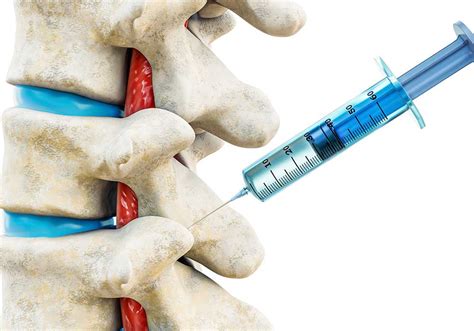 Facet Joint Injection And Medial Branch Blocks - OPMSM