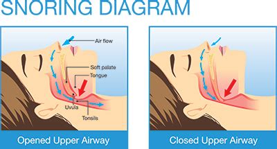 Sleep Apnea Surgery Options - Corbinlibrary