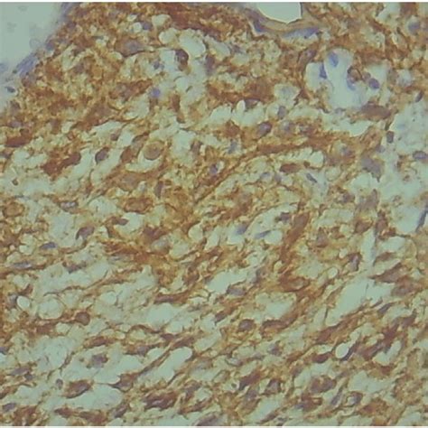 Foci of hemosiderin deposition are characteristic (HE staining, ×100). | Download Scientific Diagram