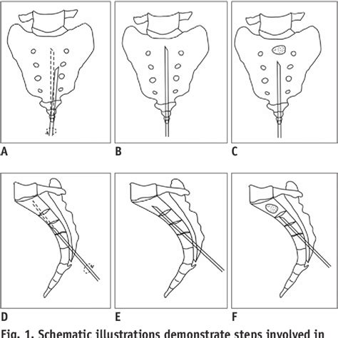 Figure 1 from Percutaneous Sacroplasty for Painful Sacral Metastases Involving Multiple Sacral ...