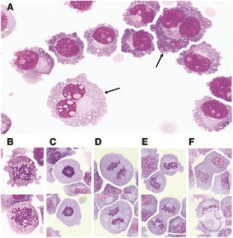 Dividing plasma cells in the cerebrospinal fluid of a patient with refractory multiple myeloma