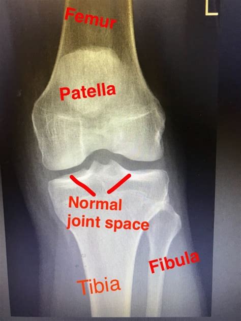 Dennis M. Lox, M.D. Explains How to Read a "Bone on Bone" Knee X-Ray