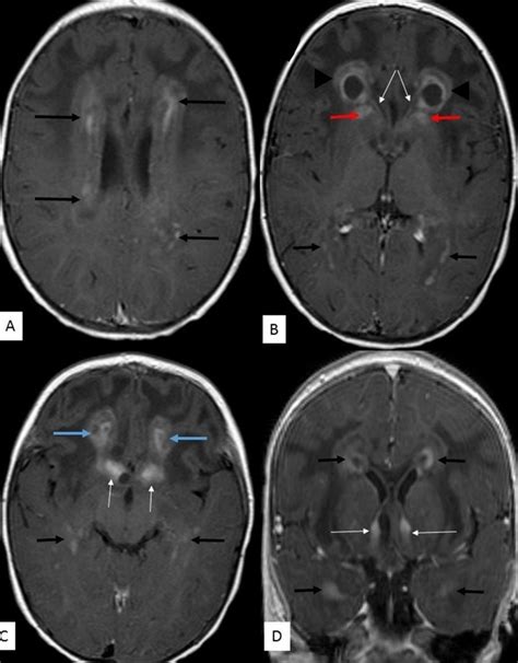 14 month old male with Alexander disease. FINDINGS: A, B,... | Download Scientific Diagram