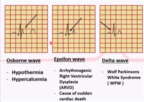 Abnormal waves EKG | Medical knowledge, Paramedic school, Medical