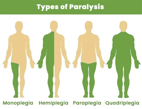 Paraplegia: Definition, Causes, Symptoms, Types Treatment, 49% OFF