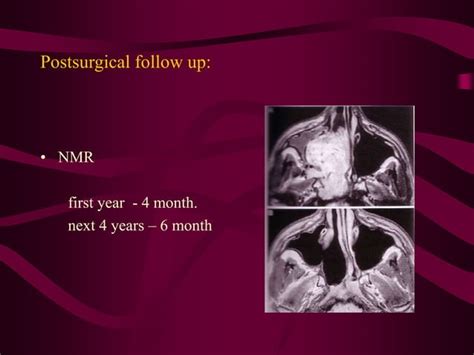 ENDOSCOPIC SURGERY FOR JUVENILE ANGIOFIBROMA