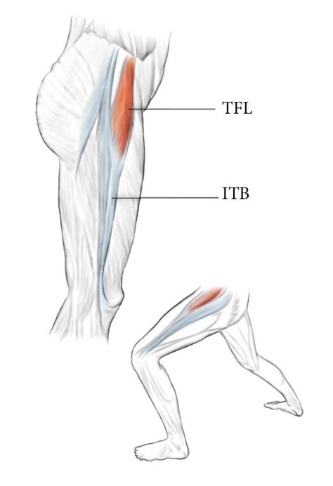 3 steps to eliminating tensor fasciae latae pain – Artofit