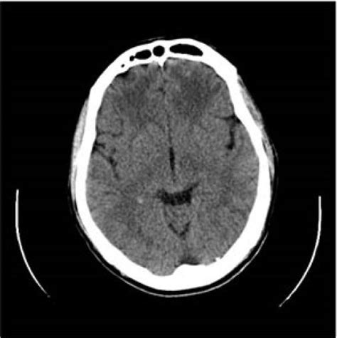 Malaria cerebral: Efectos neuropsicológicos - NeuroClass