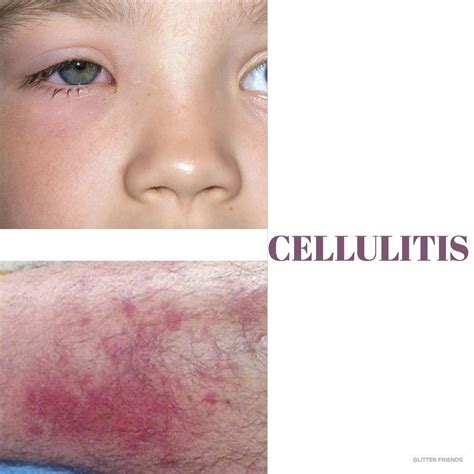 Cellulitis an infection of the skin, caused by bacteria – usually streptococcus or ...