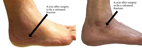 life after a calcaneus fracture surgery - Warner Partridge