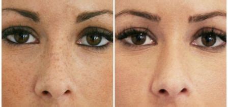 Laser Freckle Removal Before and After picture | Laser freckle removal, Freckles, Laser treatment