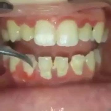 Full mouth debridement – Artofit