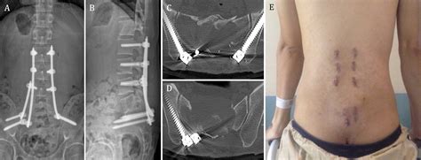 Minimally invasive dual iliac screw, dual rod fixation in a rare case of pathological sacral ...