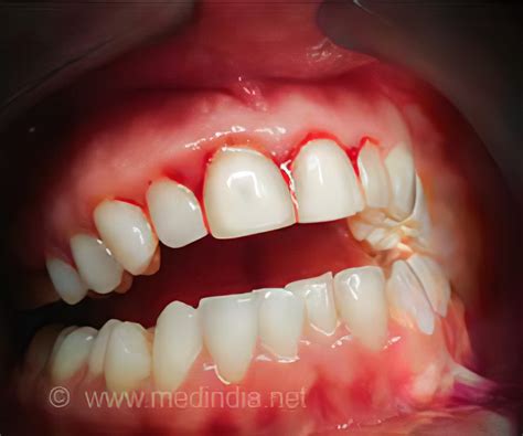 Gingival Hyperplasia