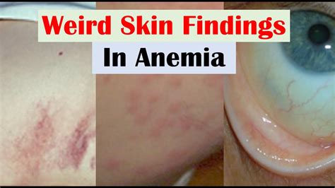 Anemia and Skin Findings (along with Nail Changes and Mouth Sores ...