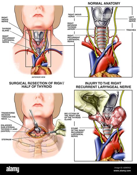 Thyroidectomy with Iatrogenic Laryngeal Nerve Resection Surgery Stock ...