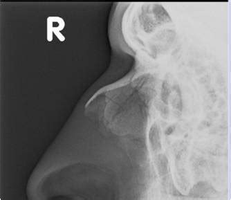 Nasal Bone Fracture X Ray