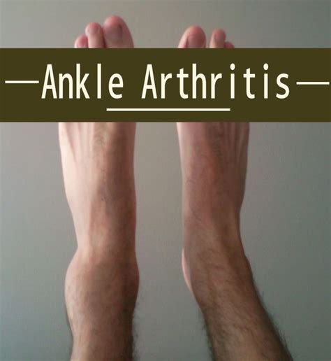 Best 25+ Ankle arthritis ideas on Pinterest | Trigger points, Body pressure points and Ankle pain