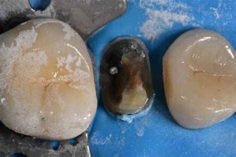 Reinforcing old Crowned Teeth Reinforcing old Crowned Teeth