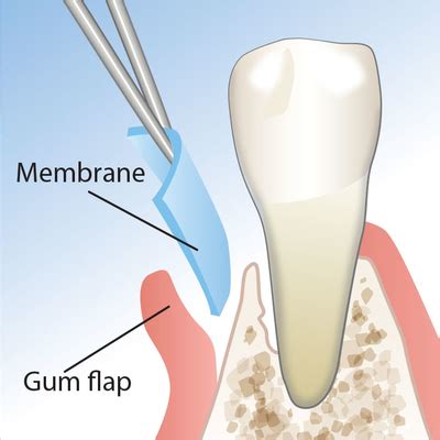 The Role Of Collagen Membranes In Dental Bone Preservation - My Dentist Toluca Lake