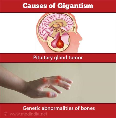 Pituitary Tumor Gigantism