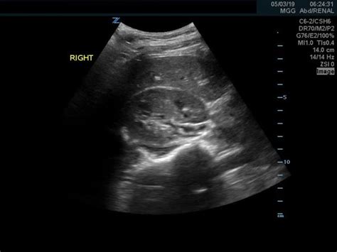 Normal Kidney Ultrasound